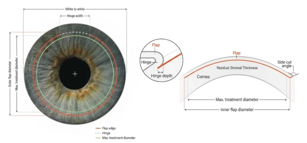 Schema tecnico che illustra la sezione e i parametri di taglio del flap corneale creato dal laser a femtosecondi